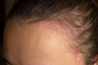 Scalp Psoriasis: What It Is, Why It Flares, and How to Manage It Day-to-Day