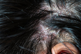 Psoriasis of the scalp - signs and symptoms