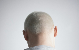 Close-up photo highlighting common scalp psoriasis symptoms