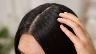 How to Get Rid of Dandruff: Treatment, Scalp Care and What to Do If It Keeps Coming Back