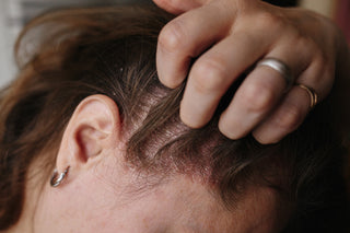 What are the different types of psoriasis?