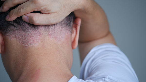How to Remove Psoriasis Scales from the Scalp Safely and Effectively