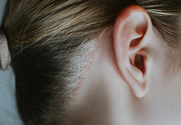 What does scalp psoriasis look like? Signs, symptoms and common visual patterns