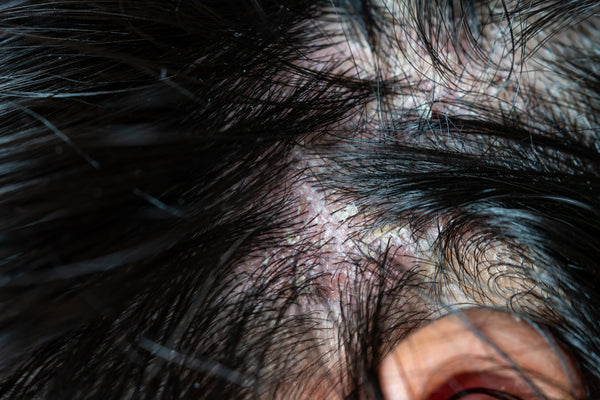 Psoriasis of the scalp - signs and symptoms