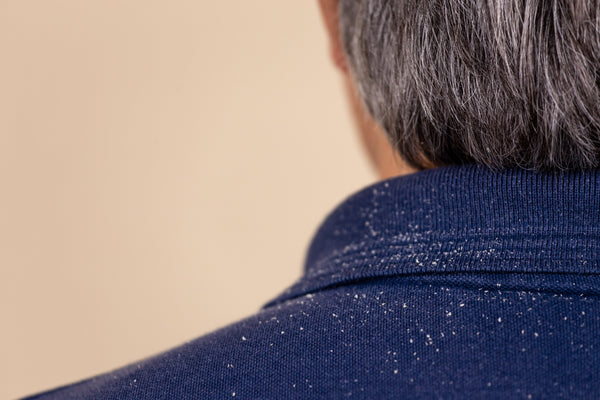 What Is Dandruff? Causes, Symptoms and How to Manage It