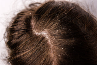 What Causes Dry Scalp? Understanding Dryness, Flakes and Underlying Scalp Conditions