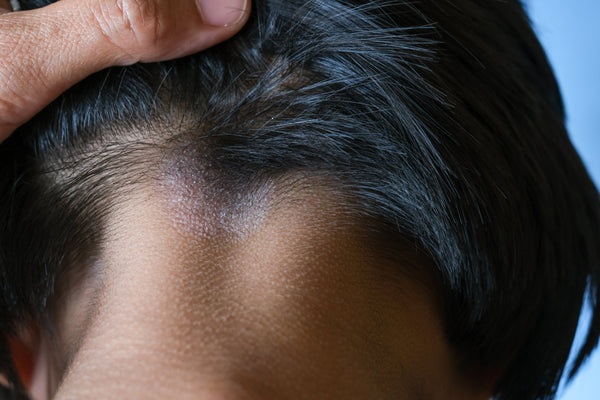What is sebopsoriasis? Symptoms, scalp signs and treatment options explained