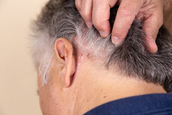 Can Seborrhoeic Dermatitis Cause Hair Loss? Understanding Shedding, Regrowth and Recovery