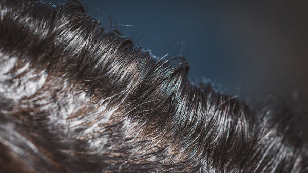 Scalp Psoriasis vs Seborrhoeic Dermatitis: How to Tell the Difference