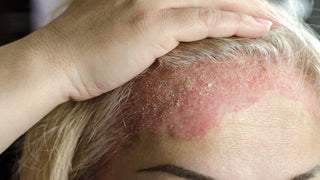 Seborrhoeic Dermatitis of the Scalp: Symptoms, Causes and Treatment Options