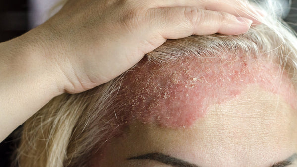 Seborrhoeic Dermatitis of the Scalp: Symptoms, Causes and Treatment Options
