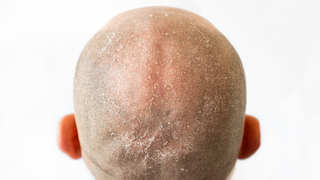 Dandruff on a Bald Head: Why It Happens and How to Treat a Flaky Scalp