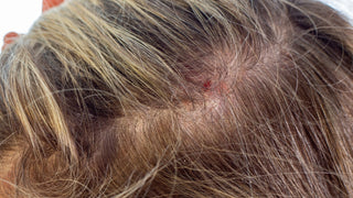 Red Spots on the Scalp: Common Causes, Symptoms and When to Seek Help