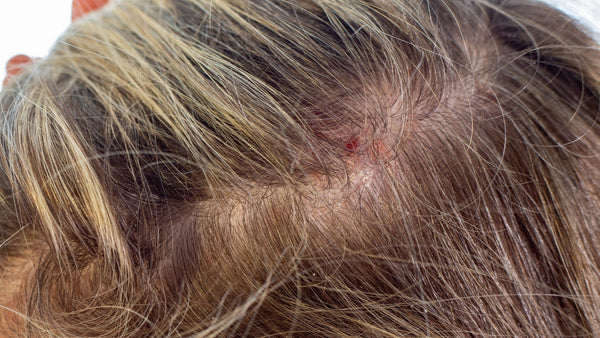 Red Spots on the Scalp: Common Causes, Symptoms and When to Seek Help