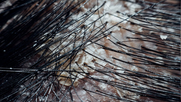 Why Do I Have Yellow Flakes on My Scalp? Causes, Treatment and When to Seek Help