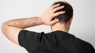 What Causes Dandruff? Understanding Why It Happens and What Can Make It Worse