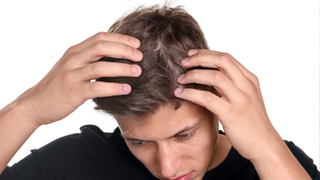 Why Does Dandruff Keep Coming Back? Understanding Recurrence and Long-Term Management