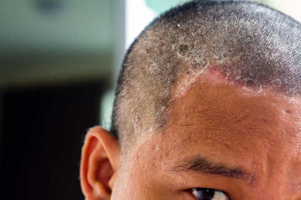 How to Choose the Right Shampoo for a Sensitive Scalp