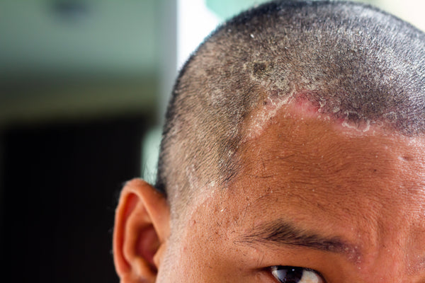 Plaque psoriasis: symptoms, causes and how it affects the scalp