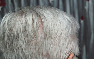 Close up image of scalp and hair of an elderly man